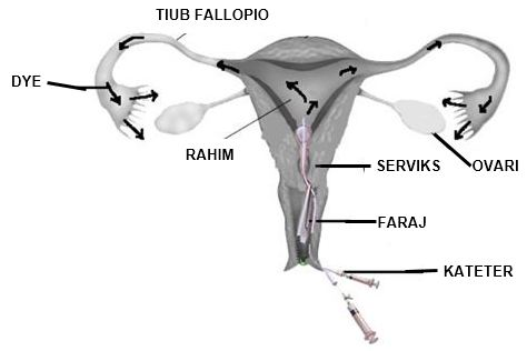 Endometriosis